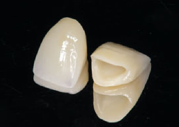 天然歯に近い色調の「オールセラミック」