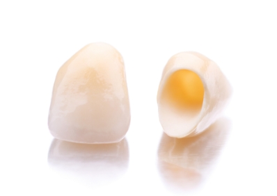 費用を抑えた「セレックセラミック」