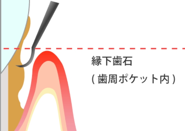 縁下歯石(歯周ポケットに付く歯石)