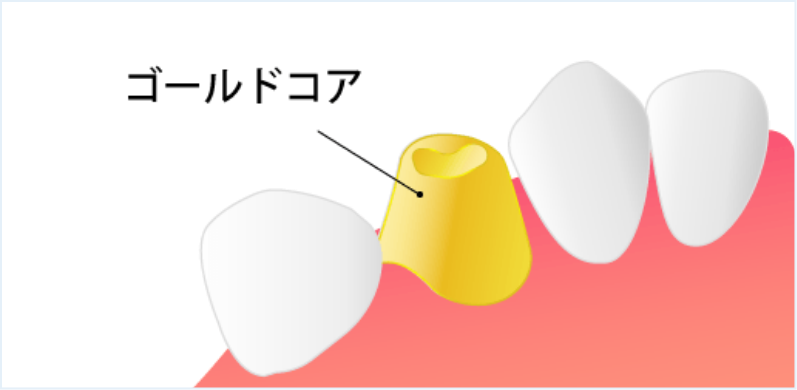 ゴールドコア